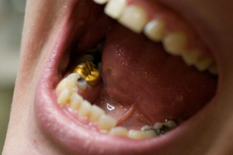 dental-fillings-gold-crown
