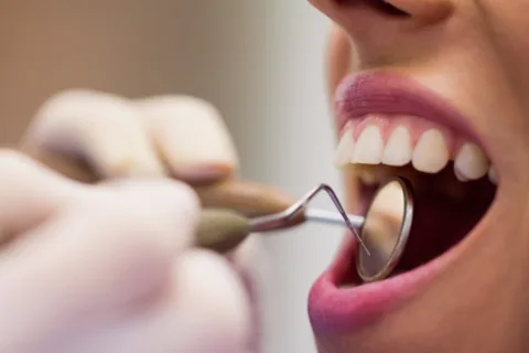 dental fillings will sometimes fall out and can be replaced quite easily