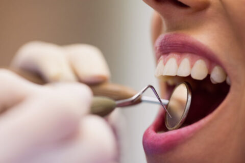 dental fillings will sometimes fall out and can be replaced quite easily