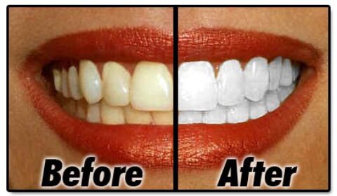 Teeth Whitening Products vs Professional Teeth Whitening From A Dentist: How Do They Compare In Terms Of Effectiveness?
