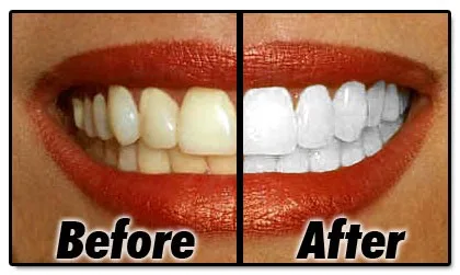 teeth-whitening-products