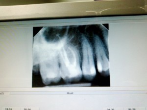 tooth-root-canal-xray