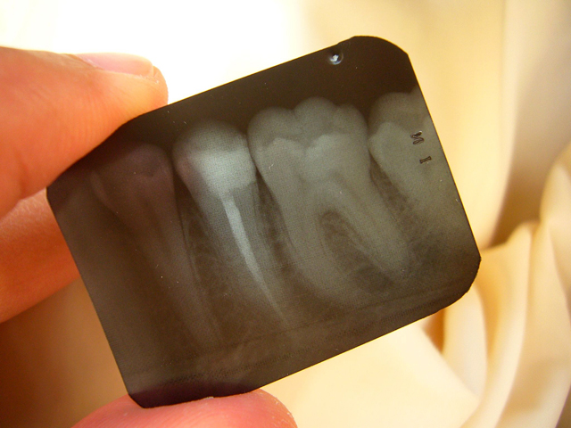 xray-tooth-root-canal